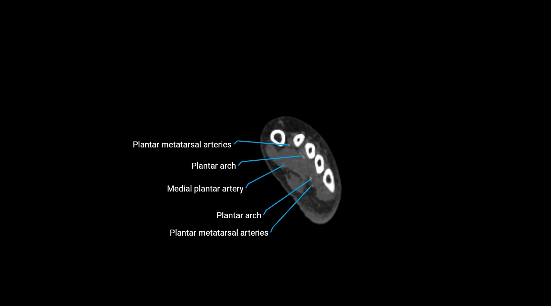 CTA lower limb cross sectional anatomy labelled image _296.webp